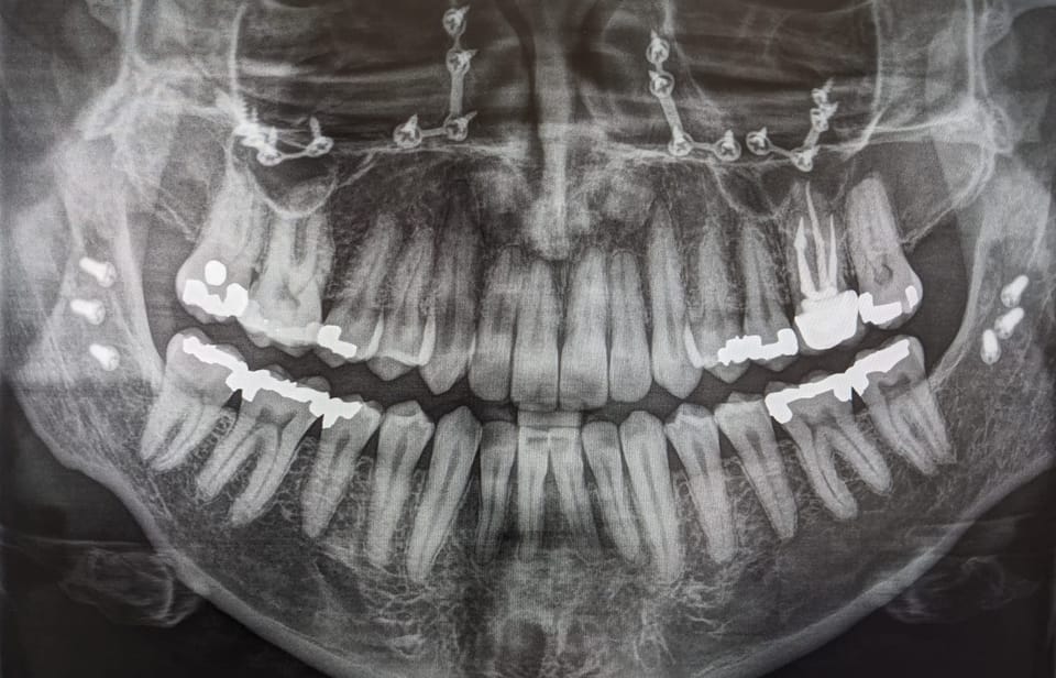 A Mouthful of Mercury No More